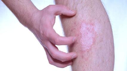 蜂產品治療牛皮癬