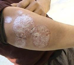 長春治療牛皮癬的醫院有哪些