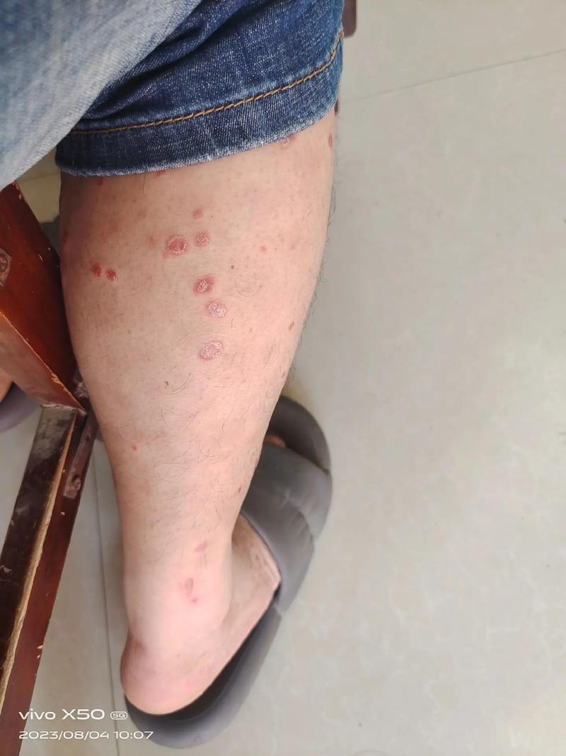 牛皮癬,又叫#銀屑病 #銀屑病 #皮膚病