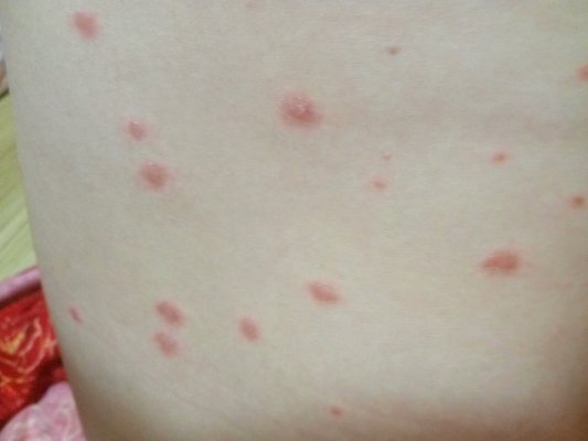 牛皮癬癥狀皮膚?