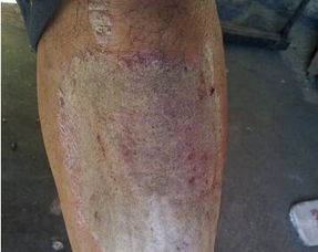 河南牛皮癬醫(yī)院怎樣選擇