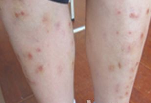 牛皮癬能治療好嗎