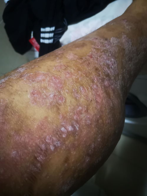 20年老牛皮癬接受可善挺治療記錄