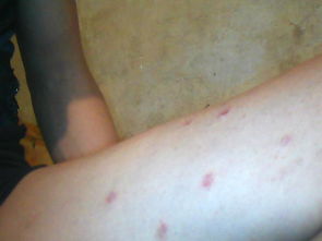 使用牛皮癬軟膏應(yīng)該注意哪些