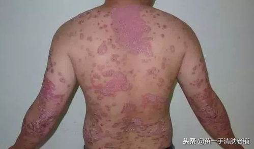 患了牛皮癬 吃這個食品,對牛皮癬的康復(fù)很有幫助