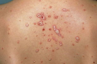 濕疹 牛皮癬怎么辨識 別傻了 一勺雞蛋清讓你搞定多年皮膚病