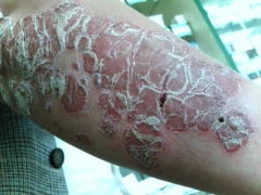 牛皮癬的發病原因