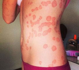 澳女孩身患牛皮癬 樂觀精神令人稱贊