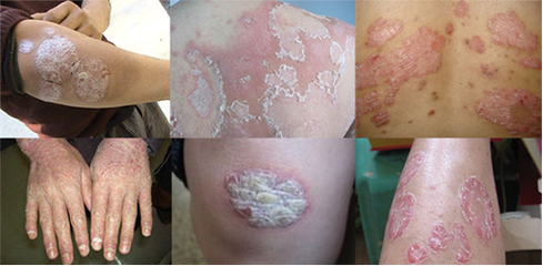 銀屑病會傳染?多半是誤傳