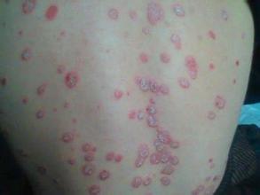 青年牛皮癬中醫病因