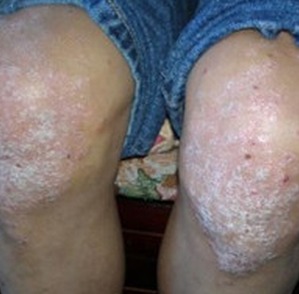 男人牛皮癬護理相關介紹