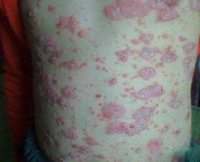 上海牛皮癬醫院哪家最好