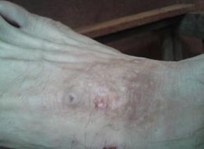 中年紅皮病型牛皮癬運動