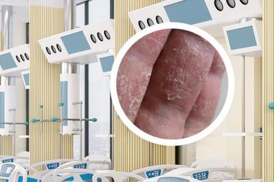 銀屑病的正規(guī)治療方法