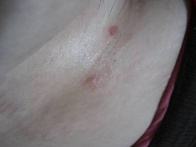 初期牛皮癬能冶好嗎