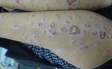 引發(fā)牛皮癬出現(xiàn)的因素是什么