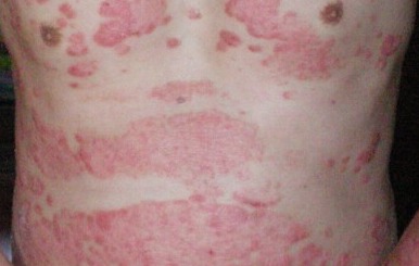 男性紅皮病型牛皮癬表現(xiàn)