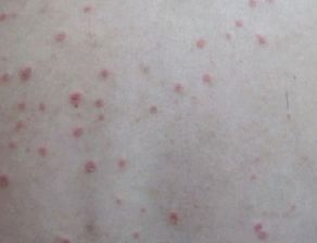 牛皮癬發(fā)作前兆是什么