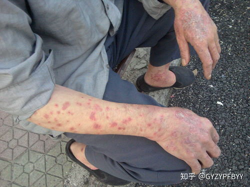 牛皮癬怎么護(hù)理,貴陽(yáng)看牛皮癬的醫(yī)院在哪里