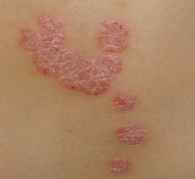 遺傳引發(fā)牛皮癬嗎