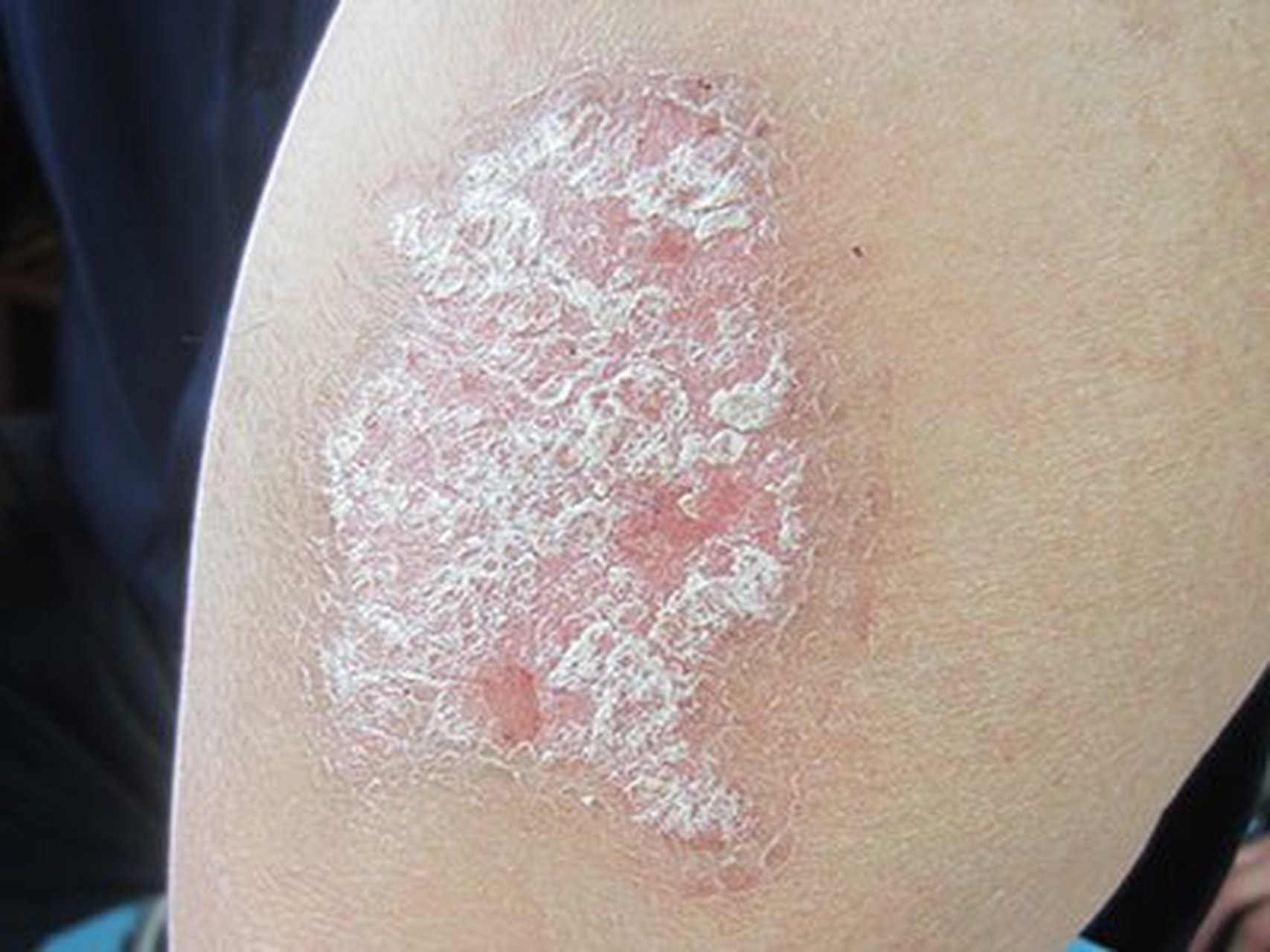 #皮膚病##頭部銀屑病# #牛皮癬# 銀屑病傳染嗎? 銀屑病可以發(fā)生在臉