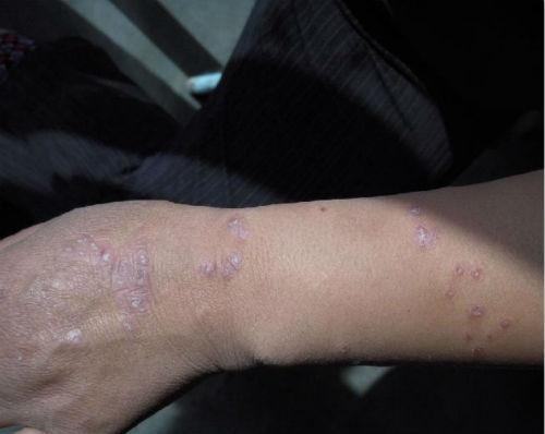 牛皮癬3種常用的藥膏,用了不易復(fù)發(fā),一人收藏,全家人不生癬