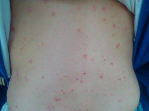 牛皮癬吃什么好一點(diǎn)呢