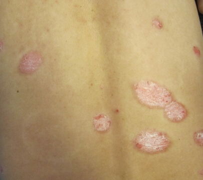 中年膿皰型牛皮癬手術(shù)治療