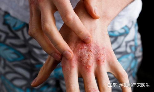 煤焦油 100多年來,一直用于銀屑病治療的外用藥