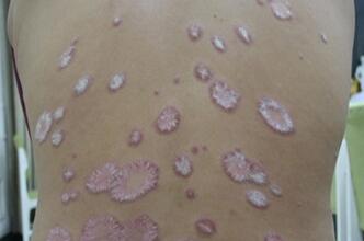 尋常型銀屑病病因