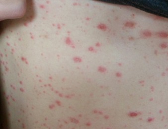 點狀牛皮癬怎么治