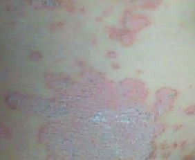 牛皮癬的人能吃海參嗎