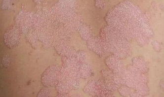 牛皮癬 銀屑病 患者注意,正確辨識,才能 過關斬將