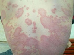 預防牛皮癬的四步攻略都有哪些