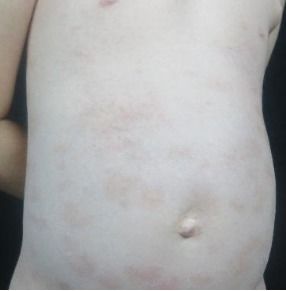 生物制劑治療銀屑病 司庫奇優單抗 蘇金 阿達木單抗 烏斯奴單抗 牛皮癬 生物治療