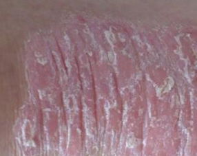 女性關節病型牛皮癬西醫診斷