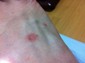 請看看是不玫瑰糠疹還是銀屑病,或者同時都有 怎么腳上的這么嚴重