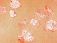 老年尋常型牛皮癬危害