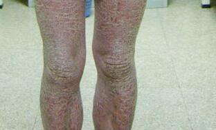 關節型牛皮癬癥狀