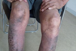 兒童關節病型銀屑病診斷