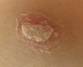 如何選擇治牛皮癬的醫院