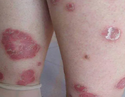 身患牛皮癬,該注意什么避免復發?