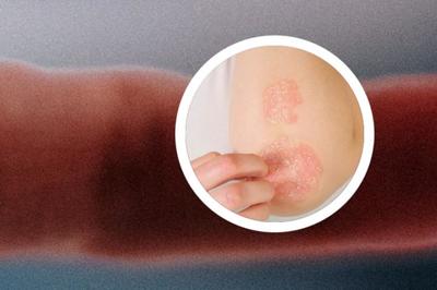 銀屑病哺乳會傳染嗎