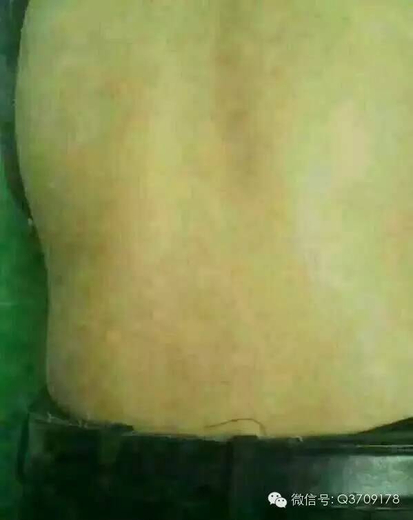 健康在轉彎處等著您 完美產品見證 多年頑固的牛皮癬看不好,完美產品出奇效 超贊