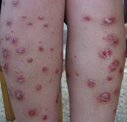 少年銀屑病壽命會有影響嗎