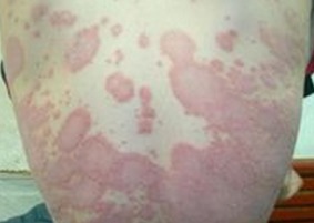 男性紅皮病型銀屑病物理治療