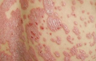 男性紅皮病型牛皮癬壽命