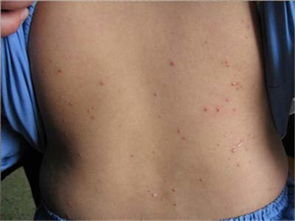 中醫解讀牛皮癬發病機理