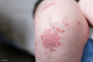 正確認識銀屑病,避免步入下面五個誤區