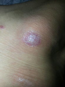 請問這是牛皮癬嘛